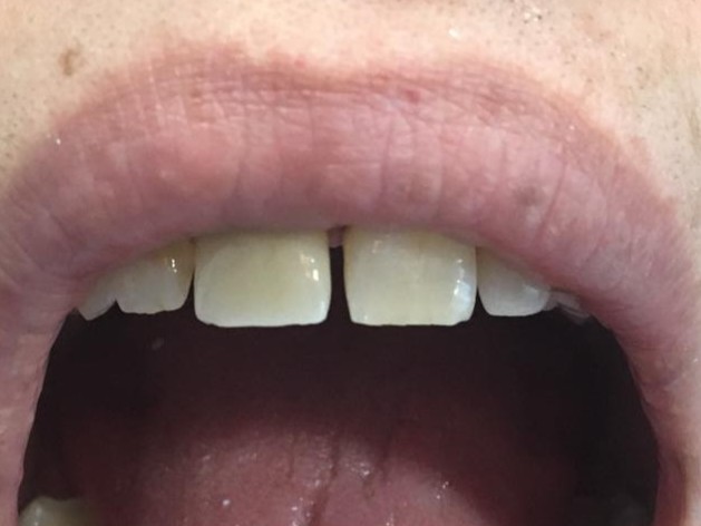 Trabajos prótesis dental