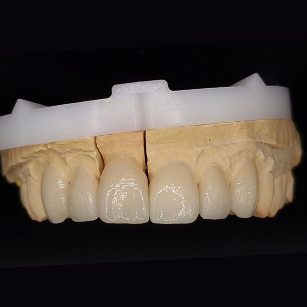 Trabajos prótesis dental