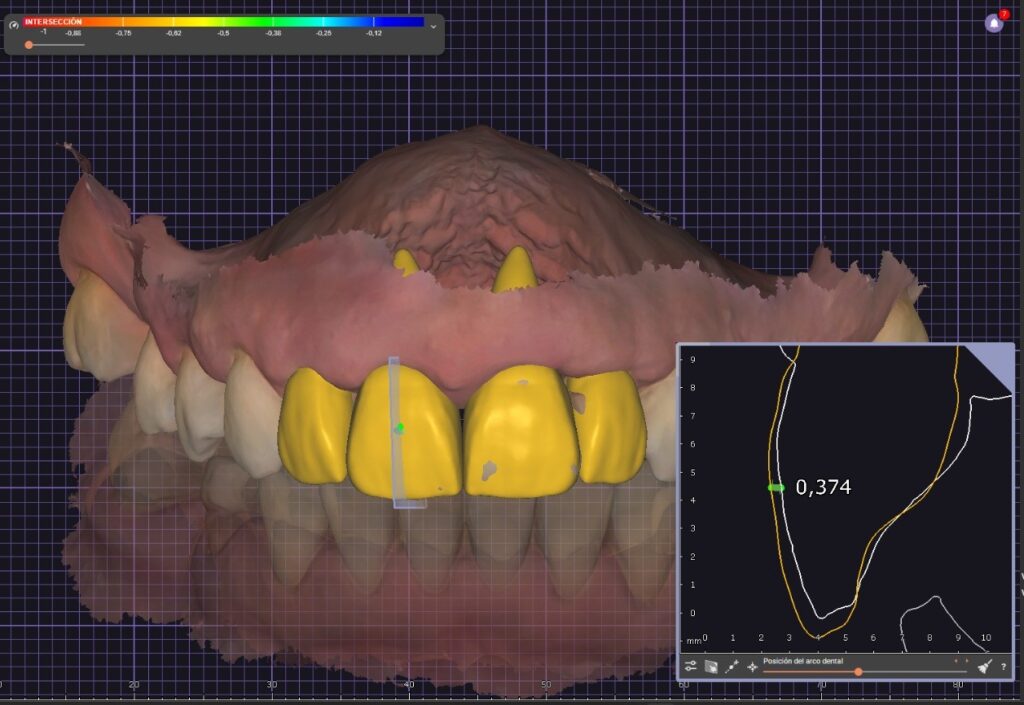 Trabajos prótesis dental