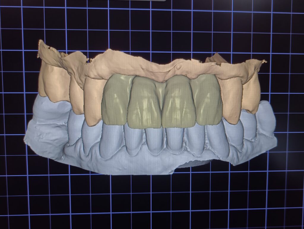 Trabajos prótesis dental