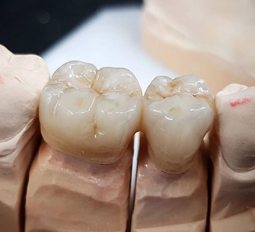 Trabajos prótesis dental