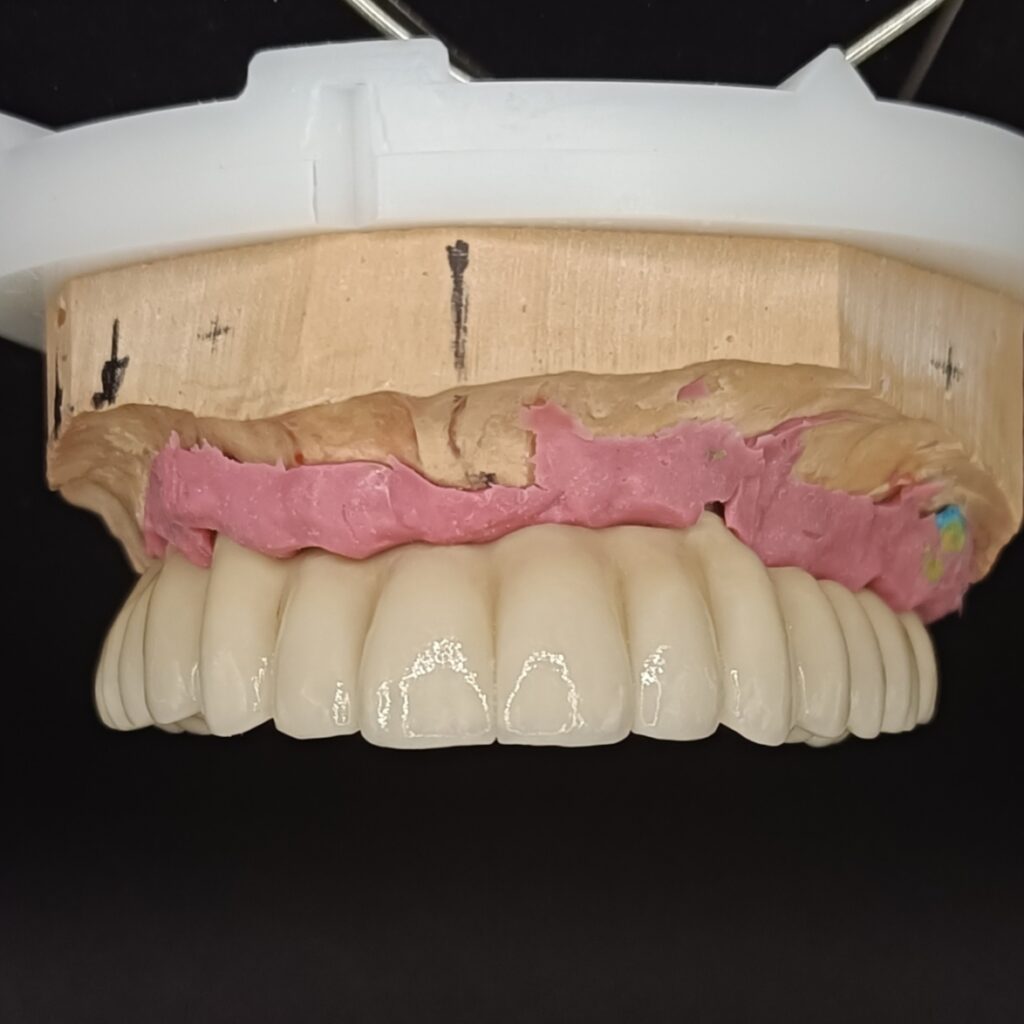 Trabajos prótesis dental