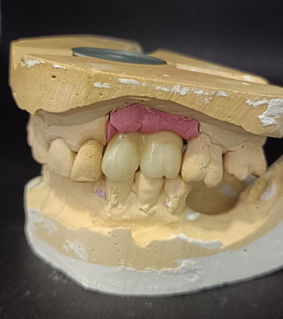 Trabajos prótesis dental