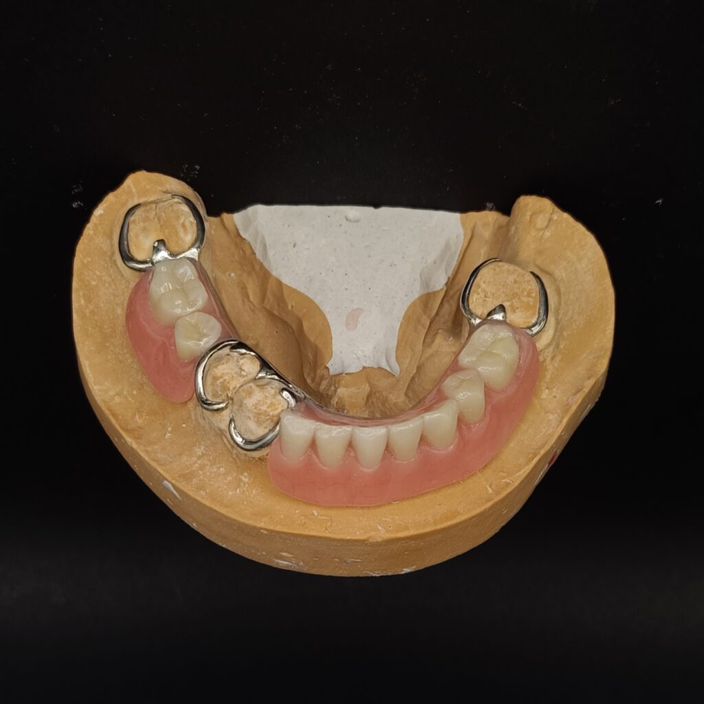 Trabajos prótesis dental